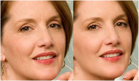 antes e despois do rexuvenecemento da pel facial en plasma