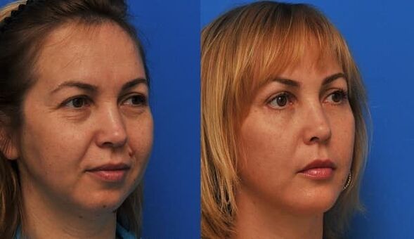 antes e despois do rexuvenecemento da pel con foto axustada 1