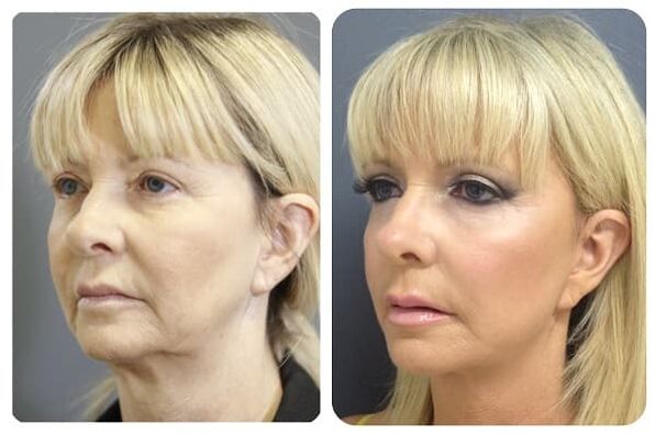 antes e despois do rexuvenecemento da pel con foto de axuste 2