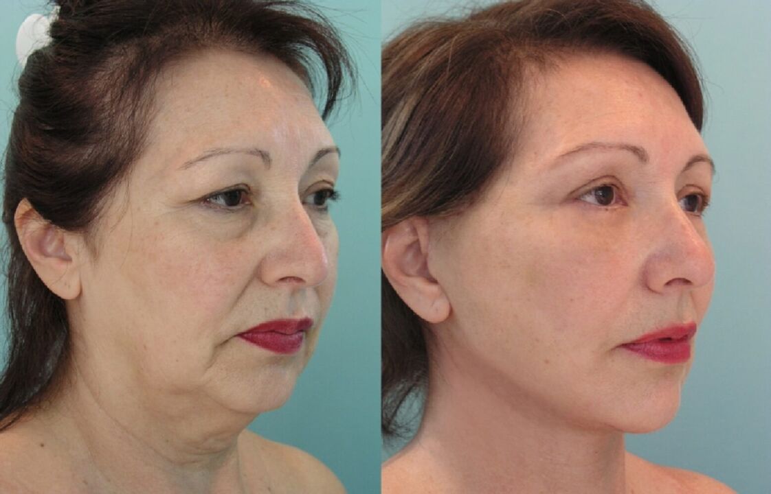 Antes e despois de lifting facial