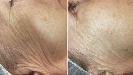 antes e despois do rexuvenecemento da pel con láser