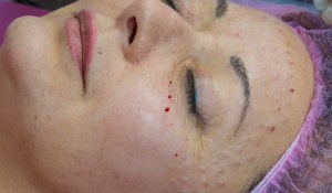 restauración da pel despois da mesoterapia