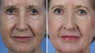 rexuvenecemento facial fraccionado antes e despois das fotos