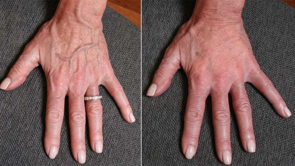 plástico de contorno, foto de rexuvenecemento da man 1 antes e despois