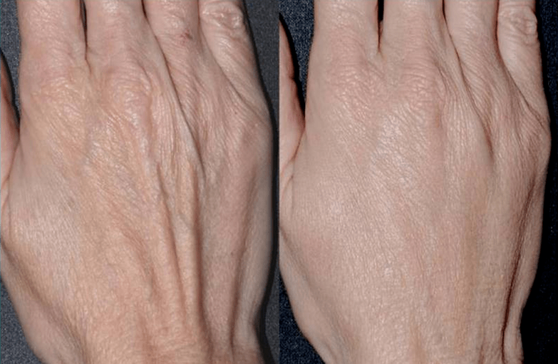 plástico de contorno, foto de rexuvenecemento das mans 2 antes e despois
